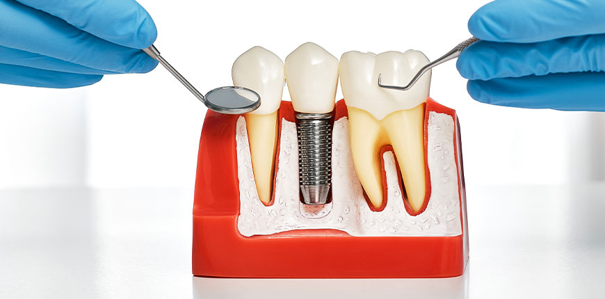 Implant Dentaire
