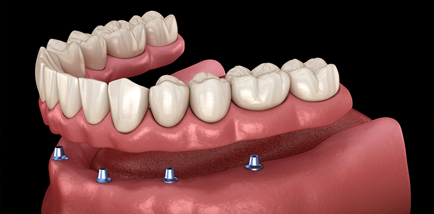 All on 4 and All on 6 Dental Implants